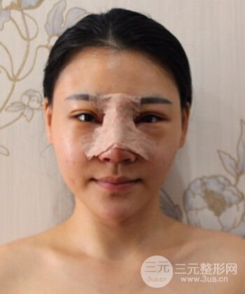 在漢中韓美做了隆鼻整形一個月，恢復越來越自然了