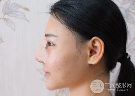 在漢中韓美做了隆鼻整形一個月，恢復越來越自然了