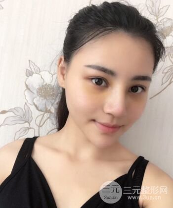 在漢中韓美做了隆鼻整形一個月，恢復越來越自然了