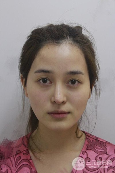 自體脂肪面部填充后成活率超高，少女感十足