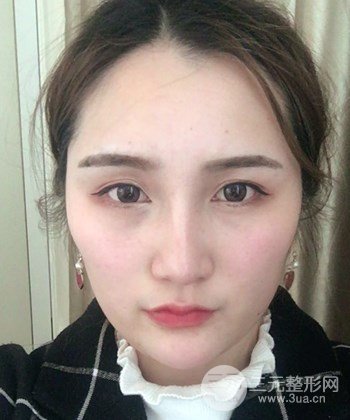 面部埋埋蛋白線.提升前后對比照片,皮膚緊致了不少