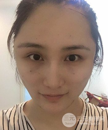 面部埋埋蛋白線.提升前后對比照片,皮膚緊致了不少