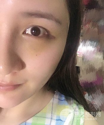 面部埋埋蛋白線.提升前后對比照片,皮膚緊致了不少