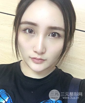 面部埋埋蛋白線.提升前后對比照片,皮膚緊致了不少