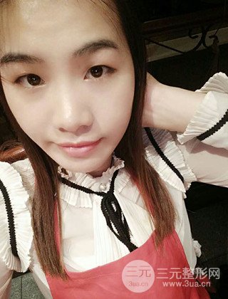 漢中韓美切開雙眼皮開眼角恢復(fù)對比照片