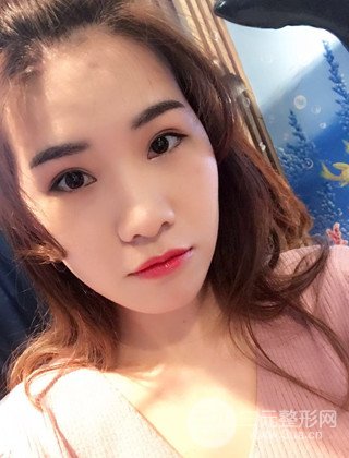 漢中韓美切開雙眼皮開眼角恢復(fù)對比照片