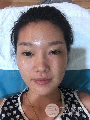 南昌永康整形打水光補水果圖前后對比