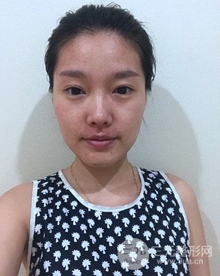 南昌永康整形打水光補水果圖前后對比