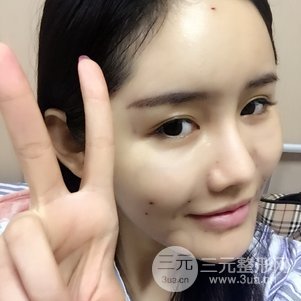 南京米尚恩陳天杰自體脂肪填充全臉 女神的養(yǎng)成記！