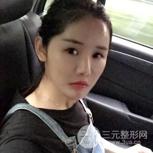 南京米尚恩陳天杰自體脂肪填充全臉 女神的養(yǎng)成記！