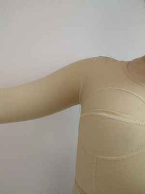 武漢天申朱天申醫(yī)生做的水動(dòng)力吸脂瘦手臂，真實(shí)案例并附上前后對(duì)比圖