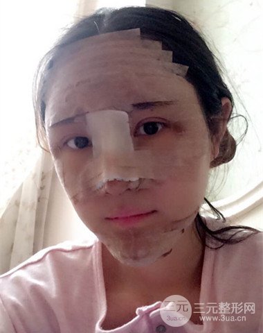 隆鼻整形+自體脂肪全臉填充前后變化實(shí)在驚人!