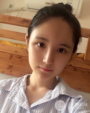 隆鼻整形+自體脂肪全臉填充前后變化實(shí)在驚人!