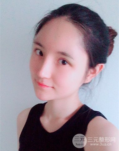 隆鼻整形+自體脂肪全臉填充前后變化實(shí)在驚人!