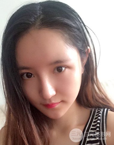 隆鼻整形+自體脂肪全臉填充前后變化實(shí)在驚人!