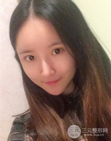 隆鼻整形+自體脂肪全臉填充前后變化實(shí)在驚人!