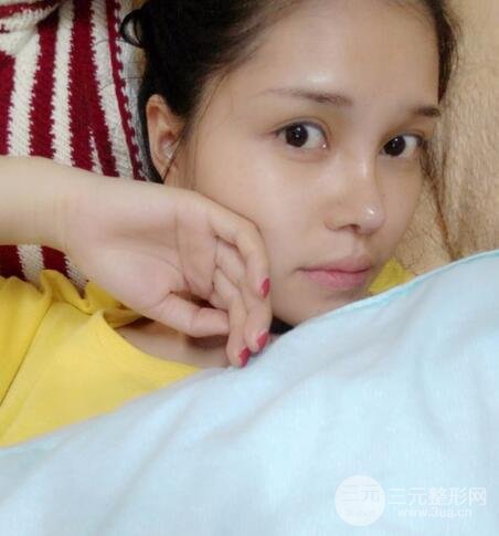 鼻頭縮小術(shù)過(guò)程圖，鼻頭縮小恢復(fù)日記