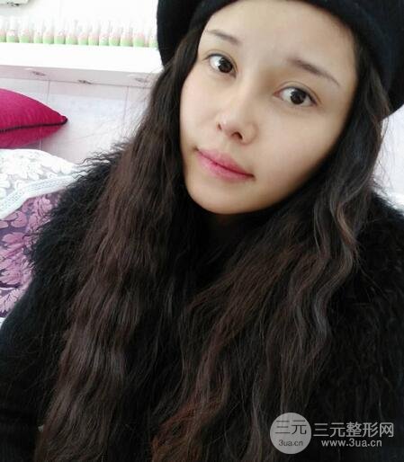 鼻頭縮小術(shù)過(guò)程圖，鼻頭縮小恢復(fù)日記