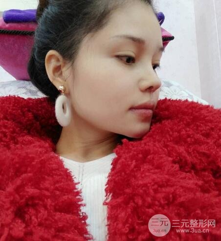 鼻頭縮小術(shù)過(guò)程圖，鼻頭縮小恢復(fù)日記