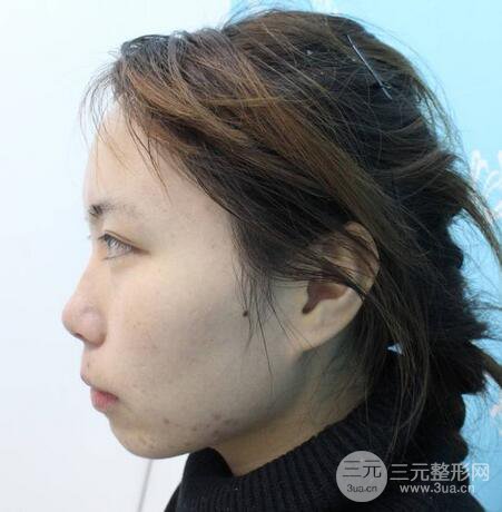 自體脂肪填充全臉基本換臉,改臉型不只是磨骨才能做到!