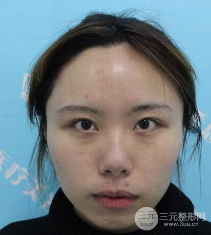 自體脂肪填充全臉基本換臉,改臉型不只是磨骨才能做到!