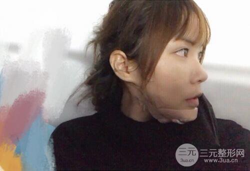 自體脂肪填充全臉基本換臉,改臉型不只是磨骨才能做到!