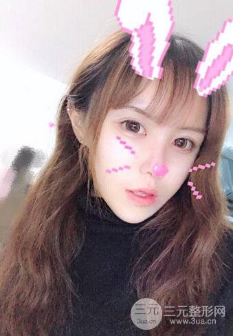 自體脂肪填充全臉基本換臉,改臉型不只是磨骨才能做到!