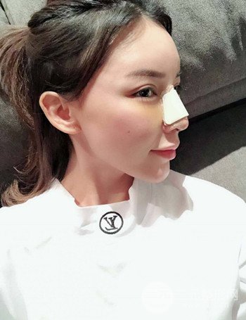 上海隆鼻失敗手術(shù)修復(fù)果超乎想象、前后對(duì)比照片分享