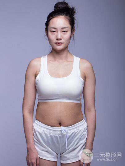 腰腹吸脂全身塑形案例