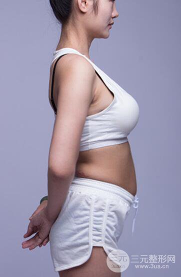 腰腹吸脂全身塑形案例