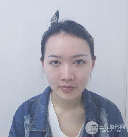 耳軟骨隆鼻全過(guò)程及術(shù)后果分享