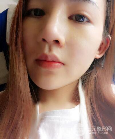 耳軟骨隆鼻全過(guò)程及術(shù)后果分享