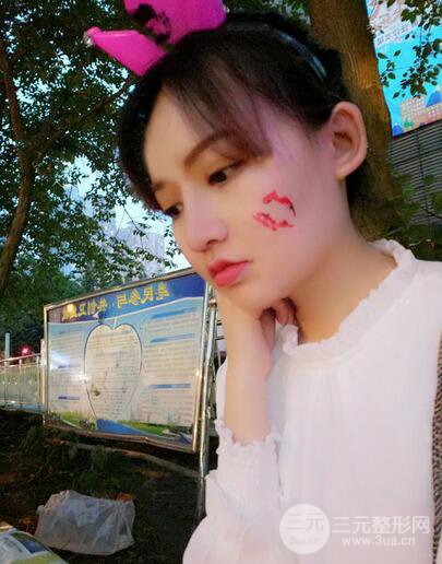 耳軟骨隆鼻全過(guò)程及術(shù)后果分享