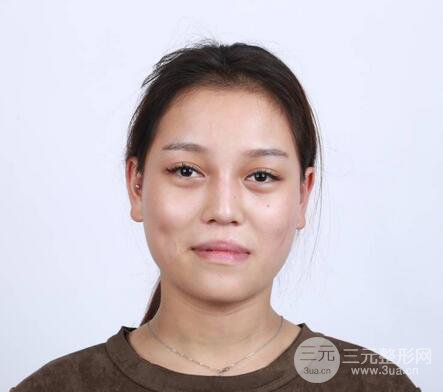 【下頜角+顴骨+下巴】全臉磨骨整形