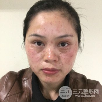 廣州激光祛雀斑果不反彈、恢復(fù)過程圖片分享