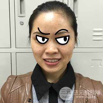 廣州激光祛雀斑果不反彈、恢復(fù)過程圖片分享