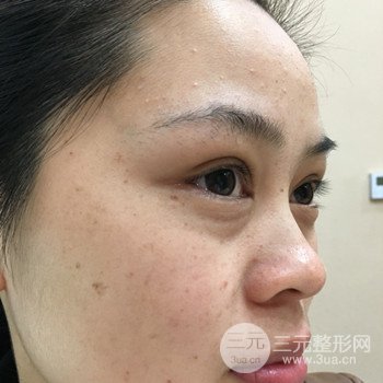 廣州激光祛雀斑果不反彈、恢復(fù)過程圖片分享