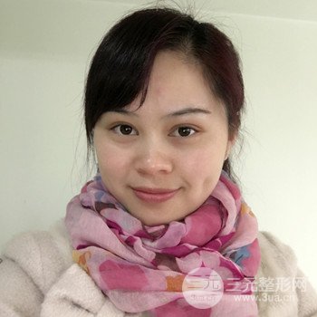 廣州激光祛雀斑果不反彈、恢復(fù)過程圖片分享