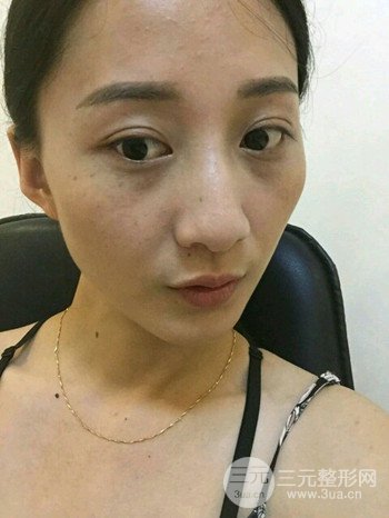 朱彤玥激光祛斑案例、兩個(gè)月果對(duì)比超明X