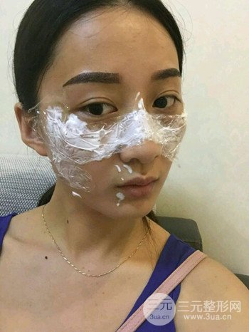 朱彤玥激光祛斑案例、兩個(gè)月果對(duì)比超明X