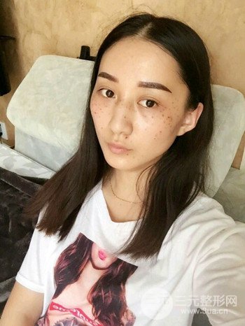 朱彤玥激光祛斑案例、兩個(gè)月果對(duì)比超明X