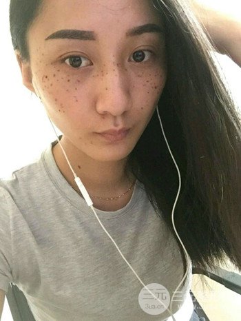 朱彤玥激光祛斑案例、兩個(gè)月果對(duì)比超明X