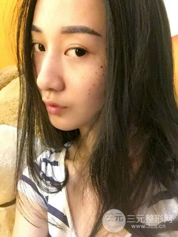 朱彤玥激光祛斑案例、兩個(gè)月果對(duì)比超明X