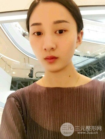 朱彤玥激光祛斑案例、兩個(gè)月果對(duì)比超明X