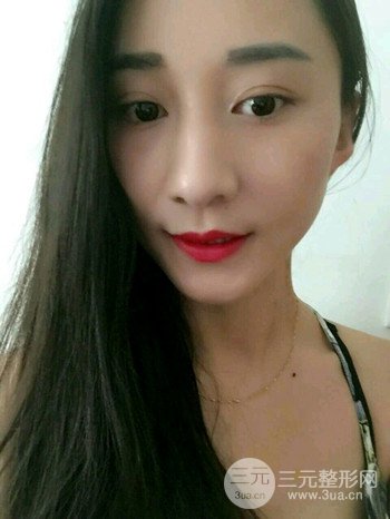 朱彤玥激光祛斑案例、兩個(gè)月果對(duì)比超明X