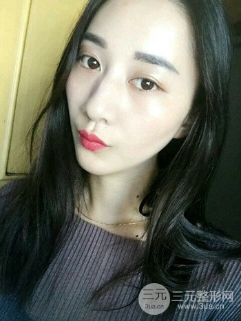 朱彤玥激光祛斑案例、兩個(gè)月果對(duì)比超明X