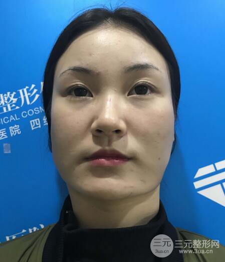 下頜角磨骨整形全過程分享，附上術(shù)后恢復(fù)照片~