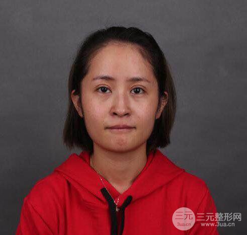 硅膠隆鼻術(shù)前術(shù)后對(duì)比照片分享，走上顏值頂峰