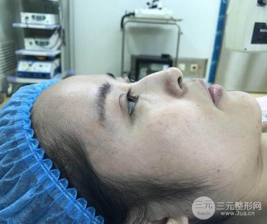 硅膠隆鼻術(shù)前術(shù)后對(duì)比照片分享，走上顏值頂峰