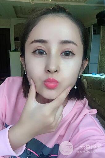 硅膠隆鼻術(shù)前術(shù)后對(duì)比照片分享，走上顏值頂峰